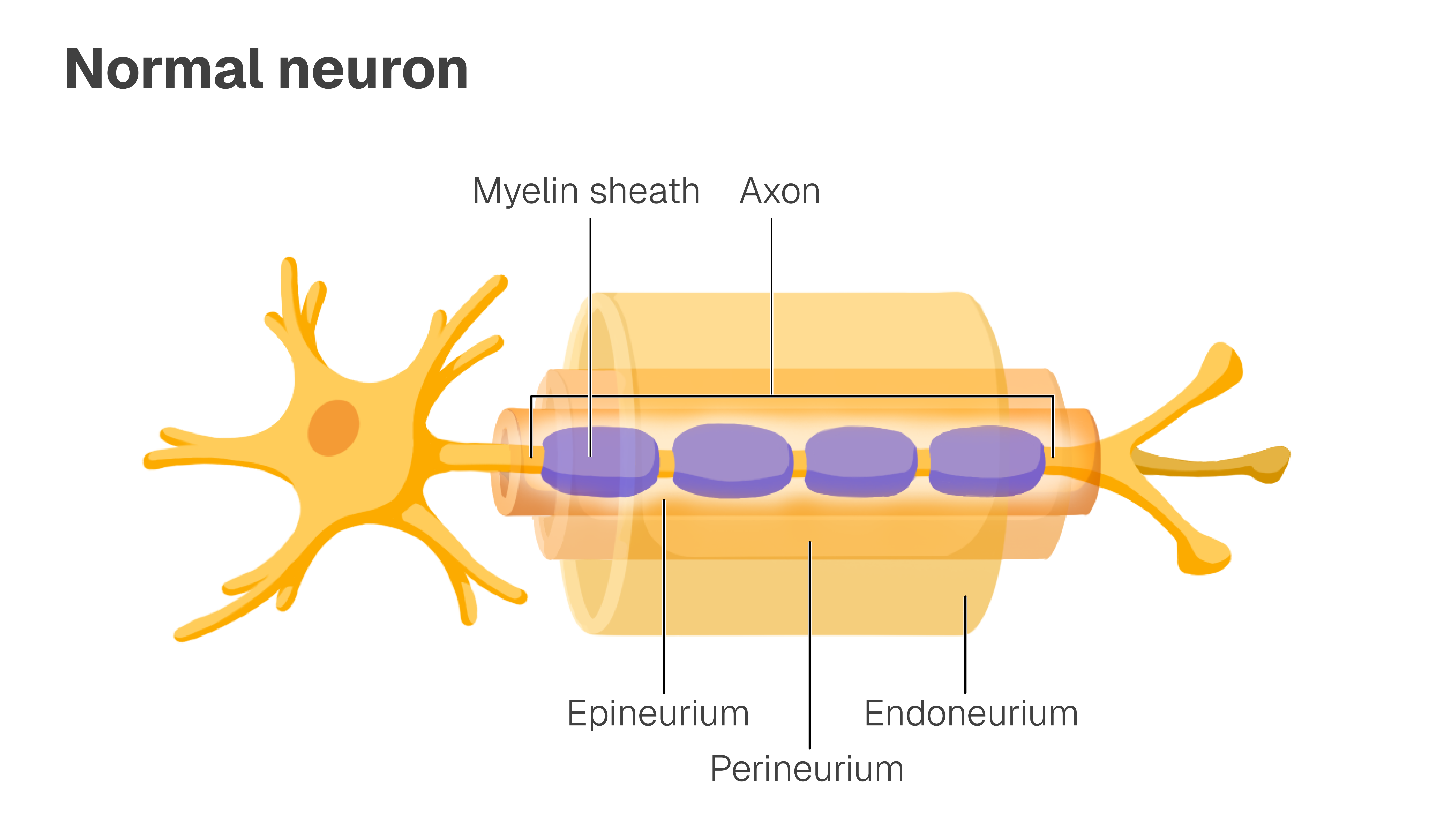 Image of normal neuron with the myelin sheath, axon, epineurium, perineurium, and endoneurium labelled.